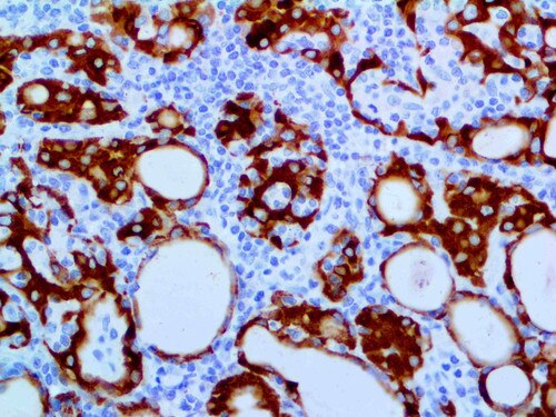IHC of Thyroid Peroxidase on an FFPE Thyroid Adenoma Tissue